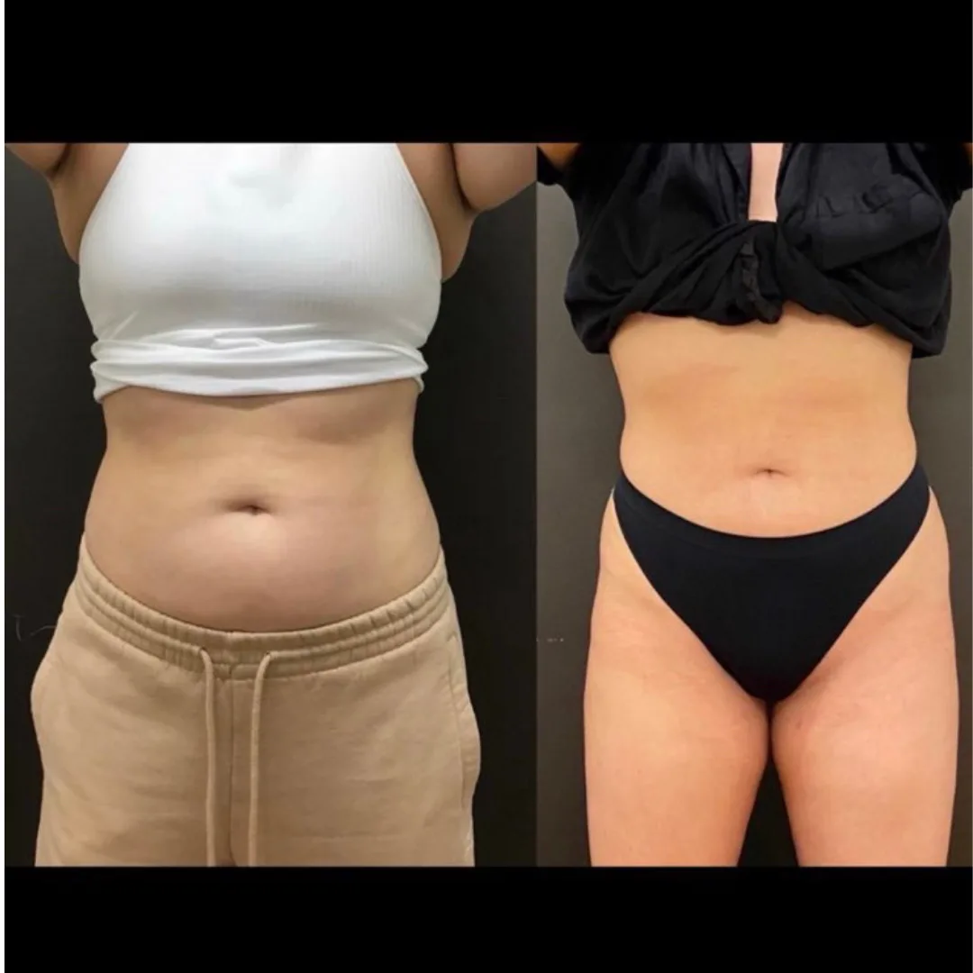 Before and after — body contouring treatment
