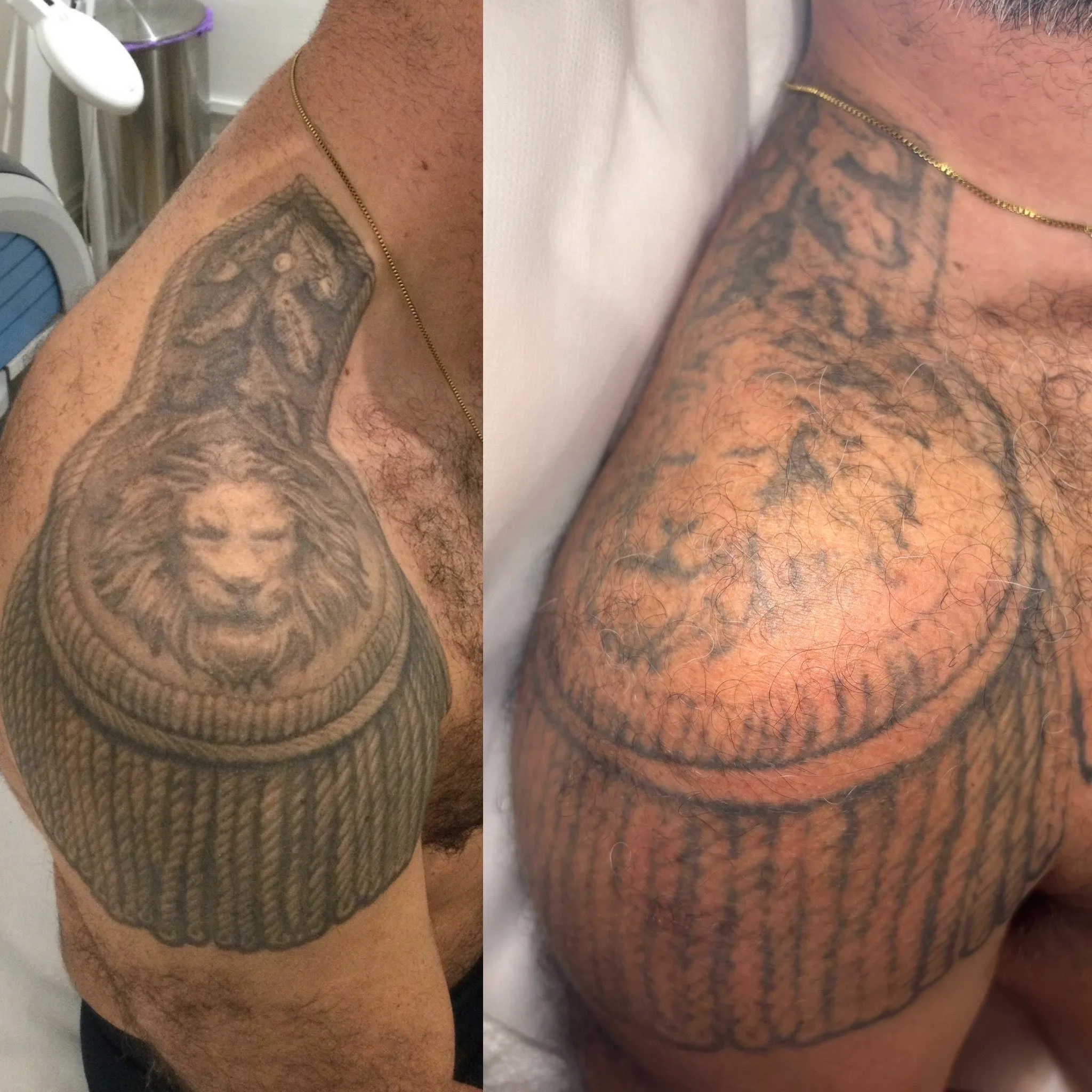 Before and after — shoulder tattoo removal with PicoSure laser