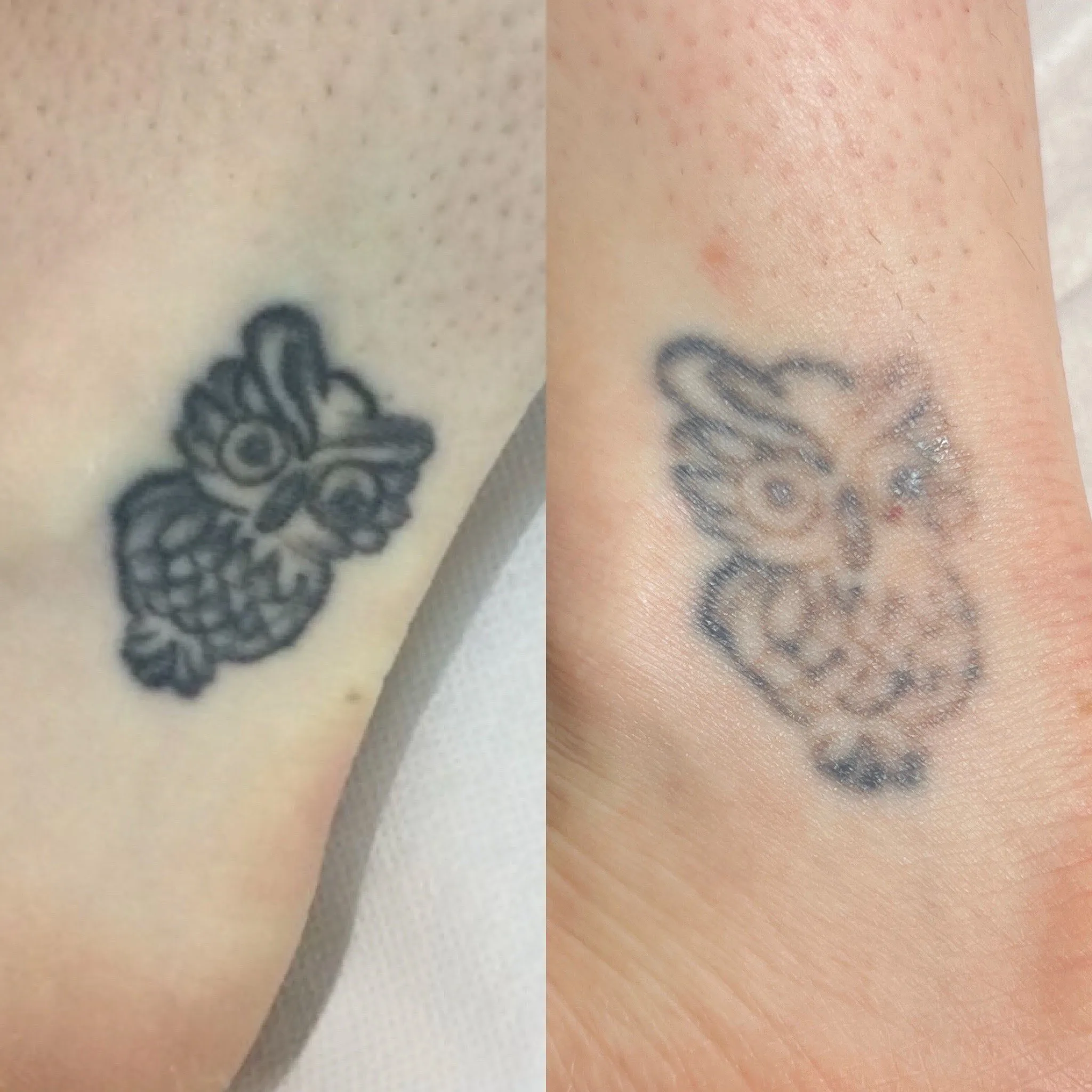 Before and after — ankle tattoo removal
