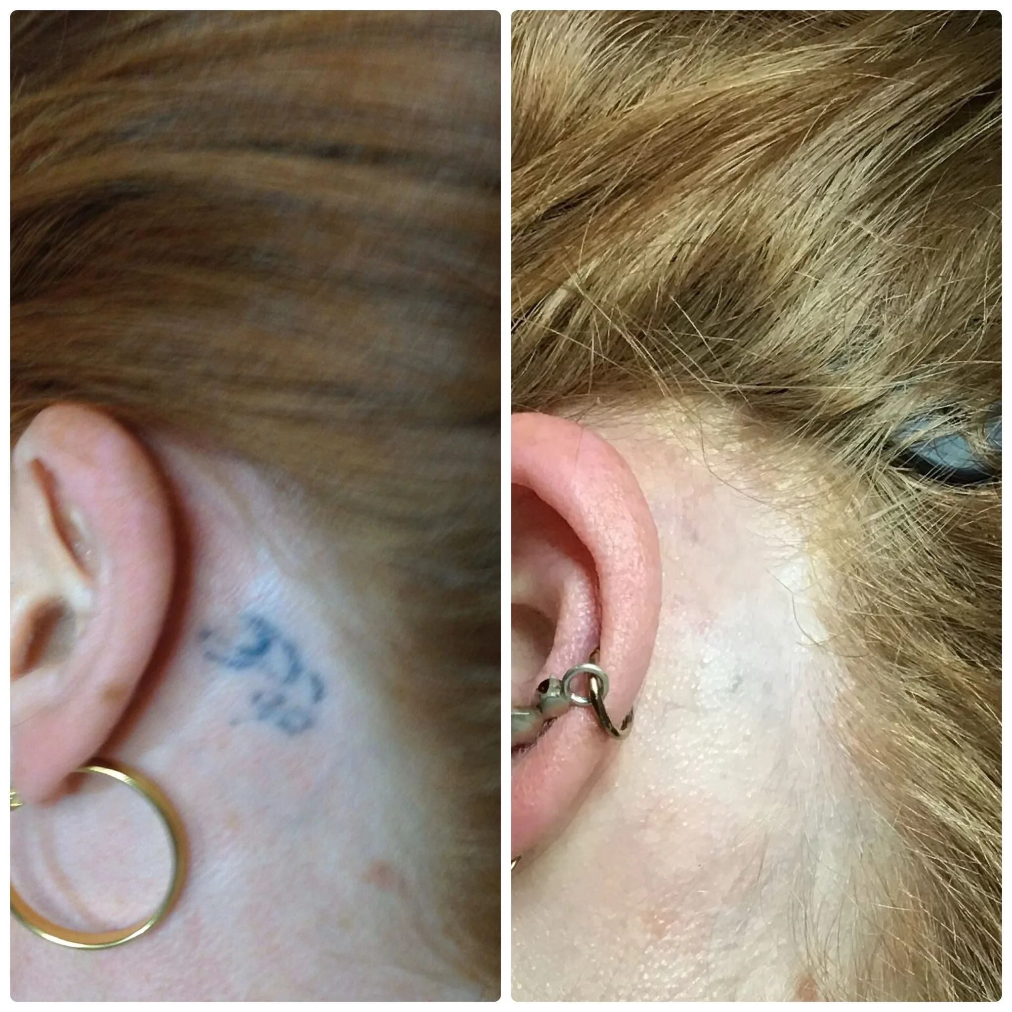 Before and after — tattoo removal behind the ear with PicoSure laser