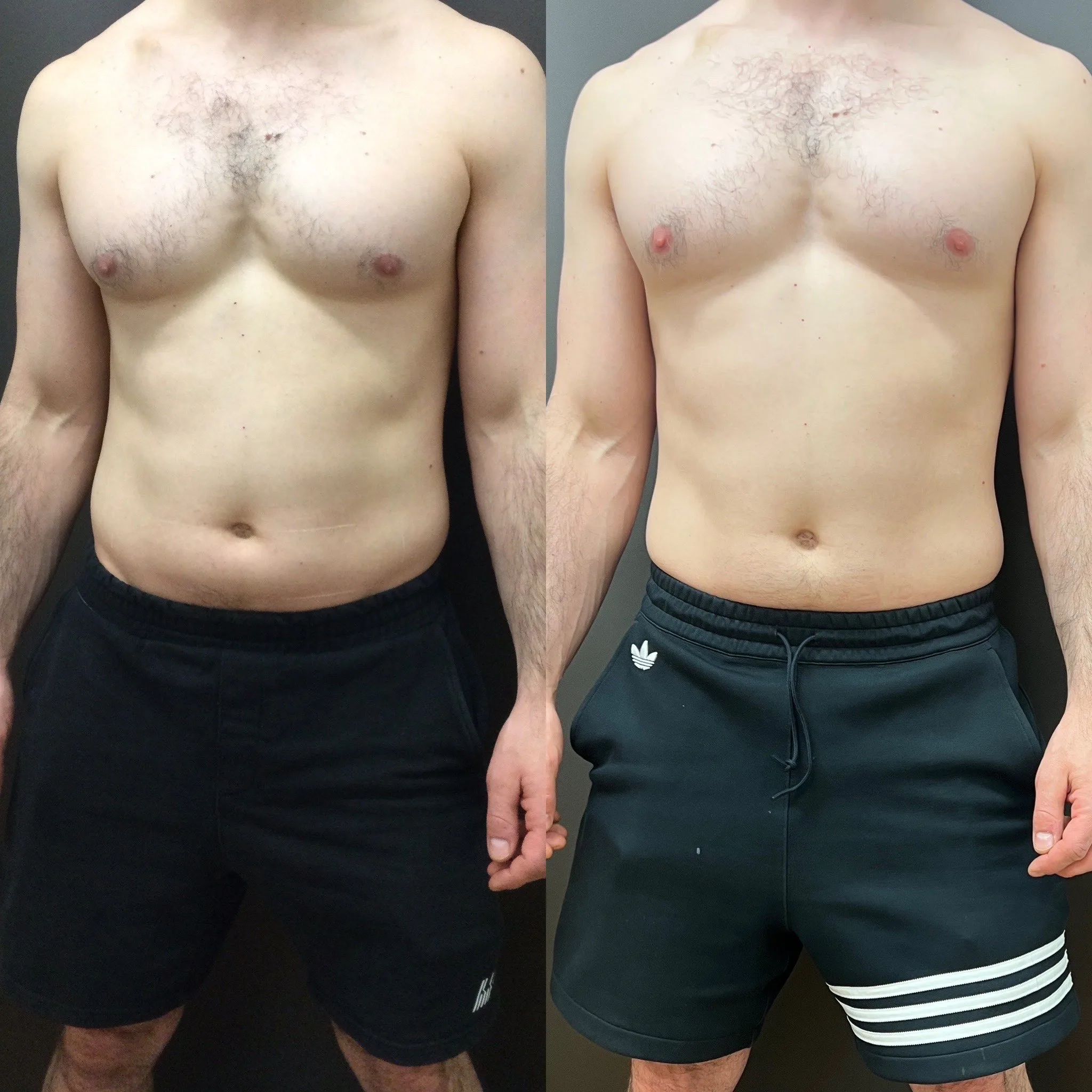 Before and after — laser hair removal result on chest