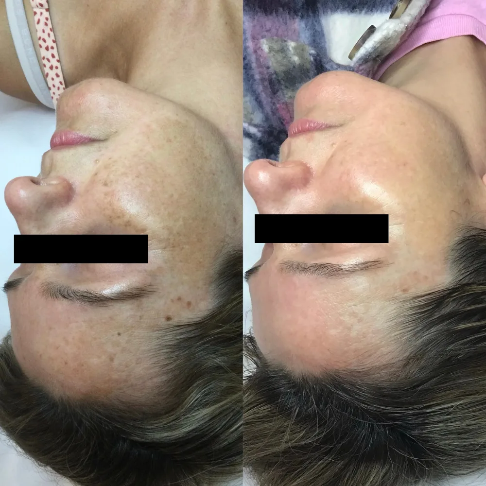 Before and after — pigmentation and skin clarity treatment