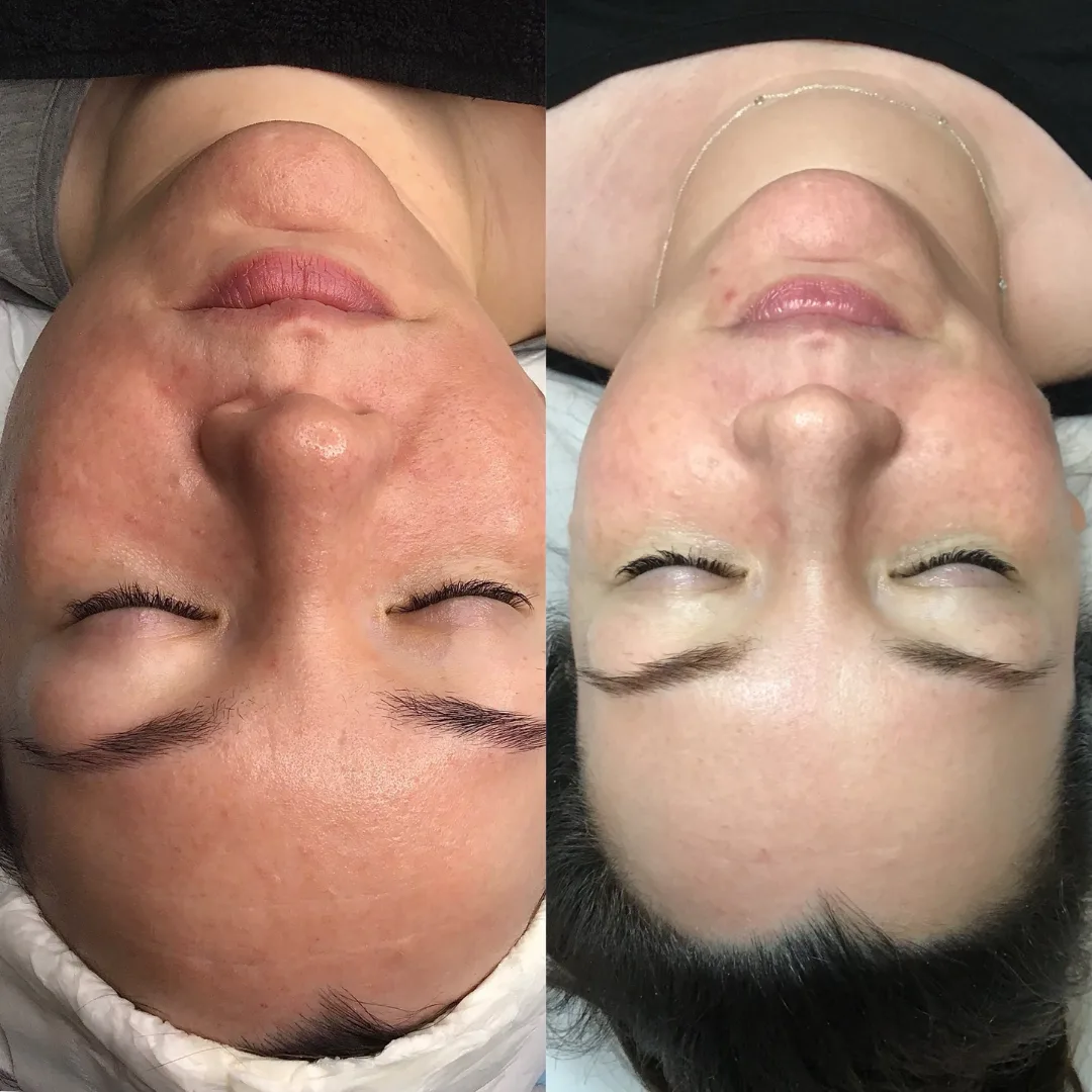 Before and after — skin pore refinement and clarity treatment