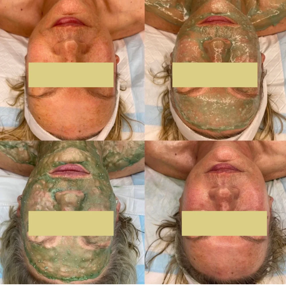 Before and after — 4-panel facial treatment result with enzyme mask