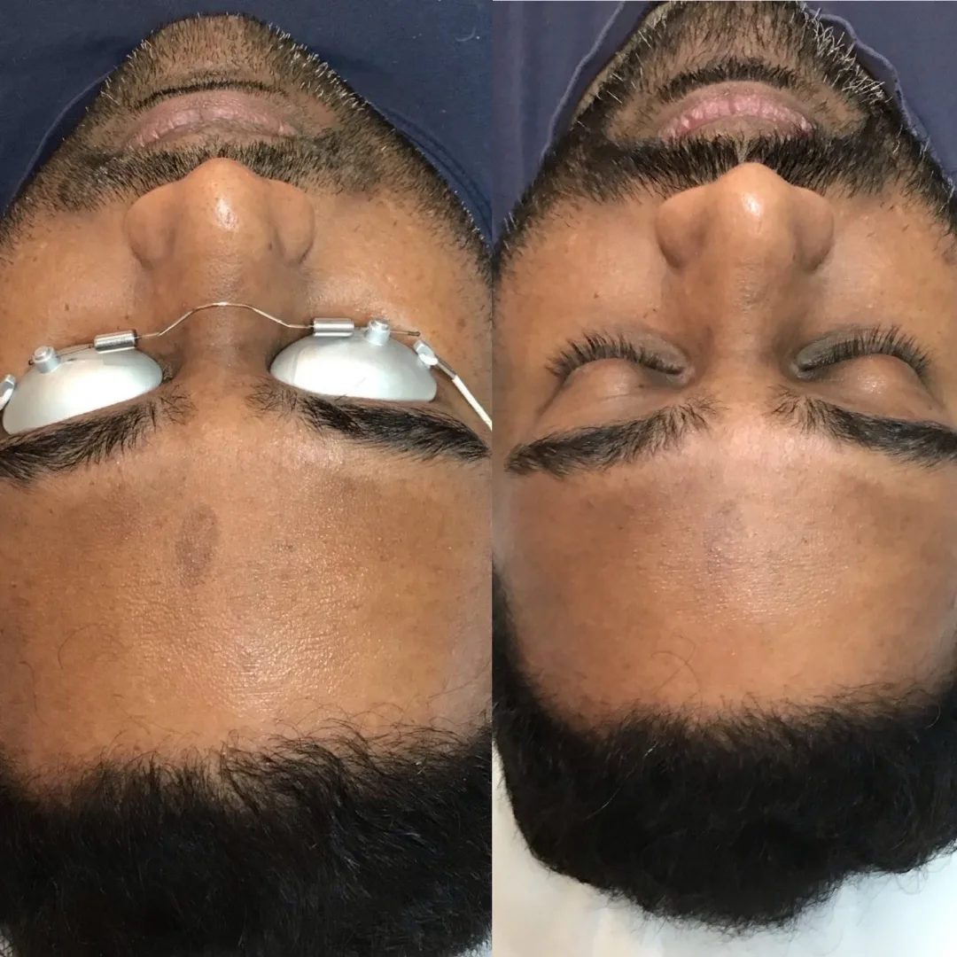 Before and after — skin treatment with laser eye shields