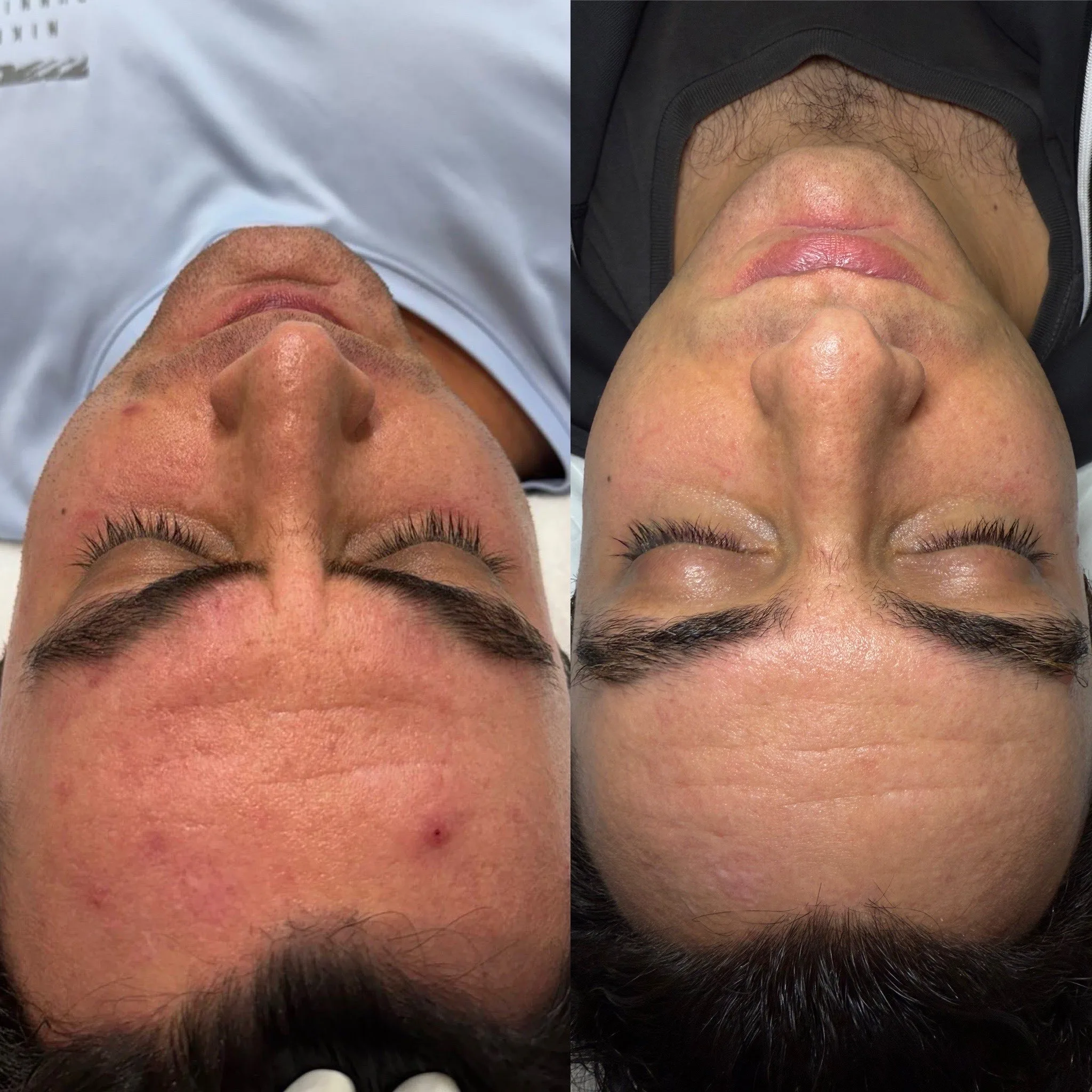 Before and after — skin texture treatment with PicoSure laser