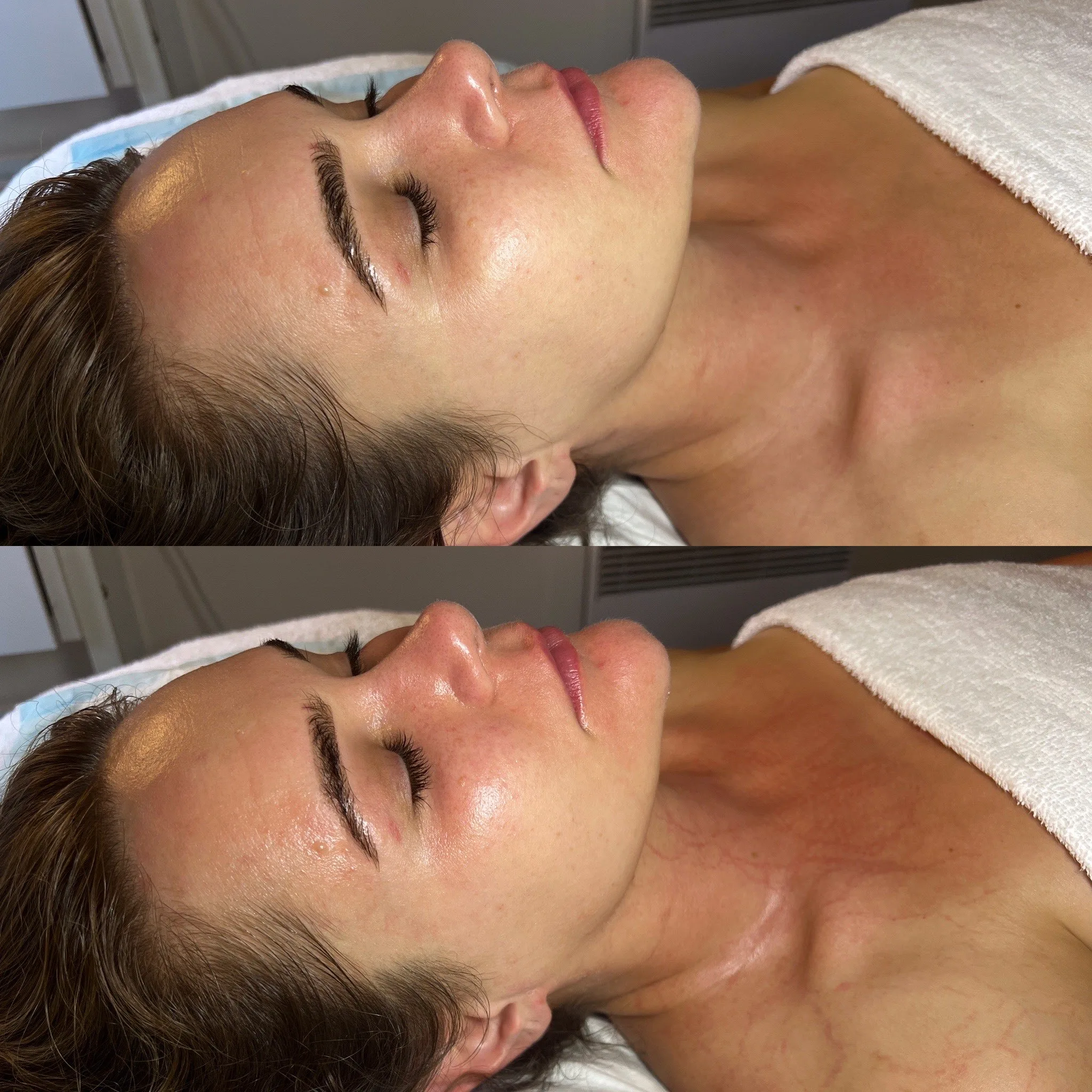 Before and after — facial skin clarity and glow treatment