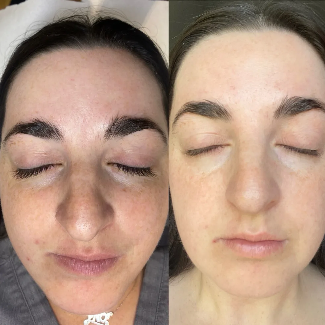 Before and after — brow and skin refinement